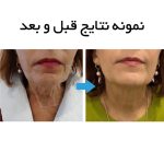 دستگاه هایفو اولترافورمر Black 13D سه هندپیس - Image 7
